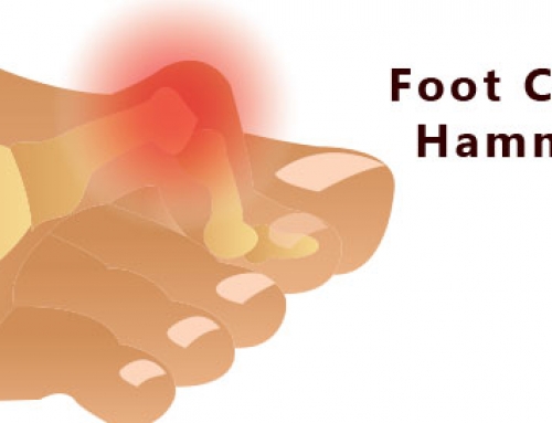 Hammer Toe Treatment | Niagara Solution
