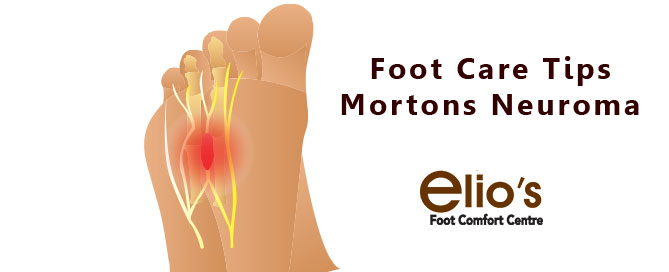 Morton's neuroma treatments | Niagara Foot Health